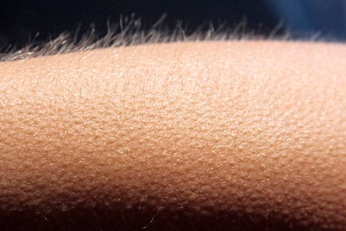 Piel erizada